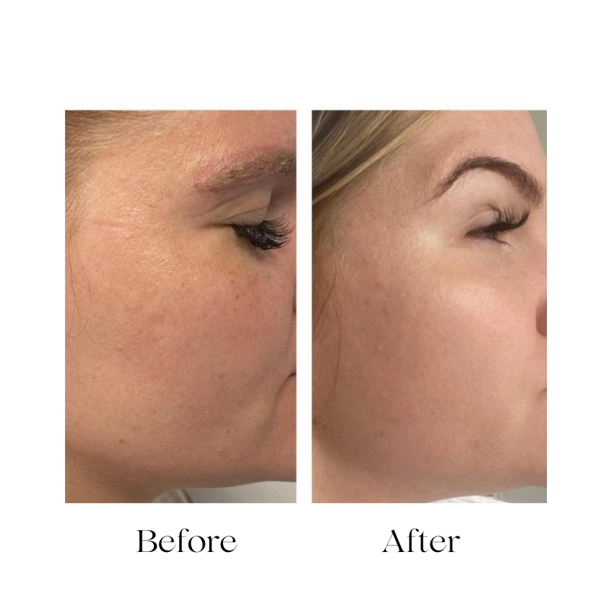 Melano Peel Cream Professional Pigmentation Care Solution